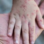 Sarampión repunta en México: 24 muertes y más de cinco mil casos