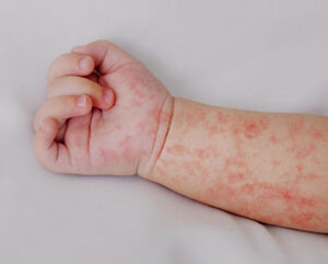 Fig_03_measles_baby_arm